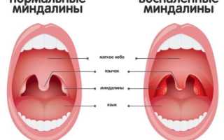 Способы промывания миндалин при тонзиллите
