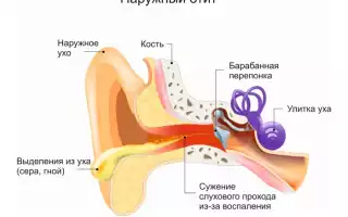Как лечить отит в домашних условиях?
